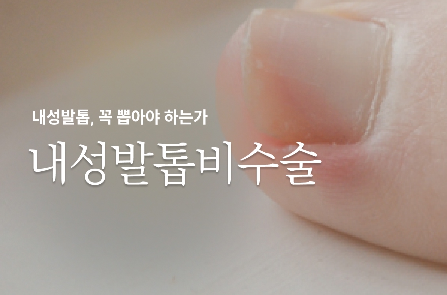 내성발톱 뽑지 않는 비수술 치료법｜통증 절감 치료 접근법
