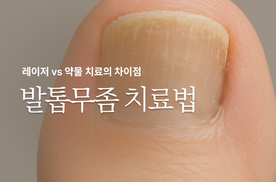 발톱무좀 치료, 레이저 vs 약물 치료 어떤 차이가 있을까?