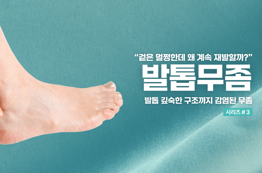 무좀약만으론 부족한 이유는? 발톱무좀의 구조적 문제