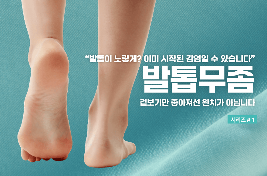 발톱무좀, 단순 무좀으로 보면 안 되는 이유
